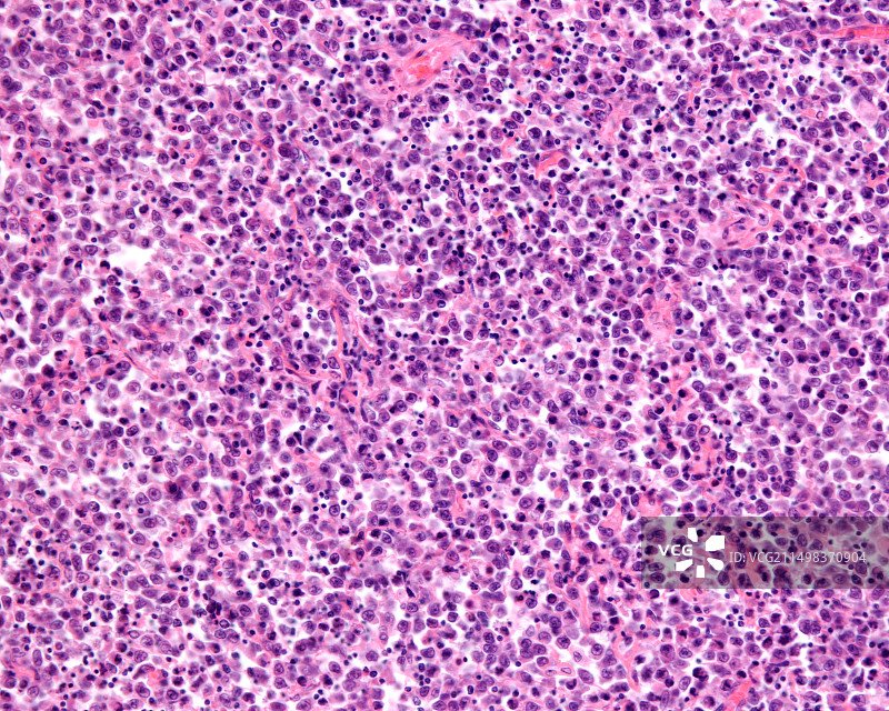 网状细胞肉瘤，光学显微照片图片素材