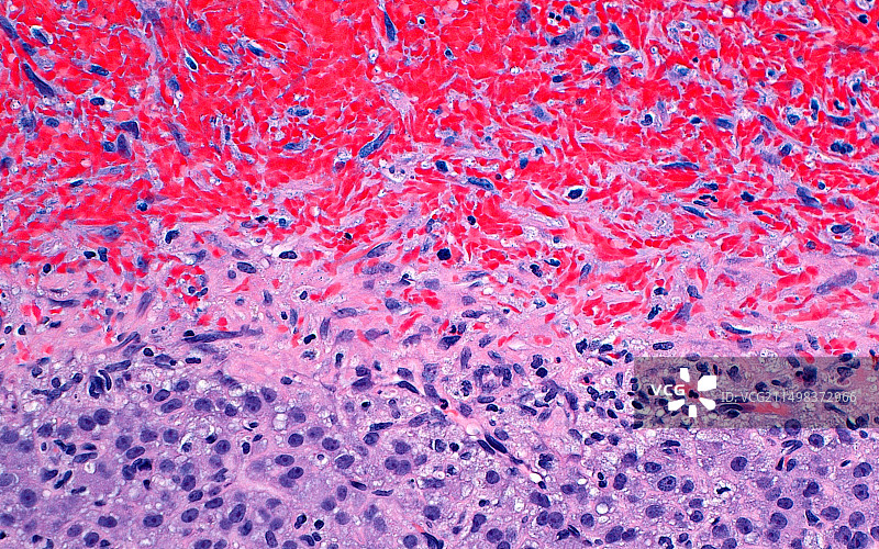 出血性黄体，光学显微照片图片素材
