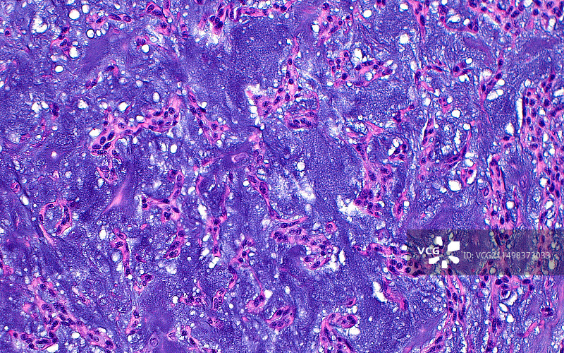 多形性腺瘤，光学显微照片图片素材