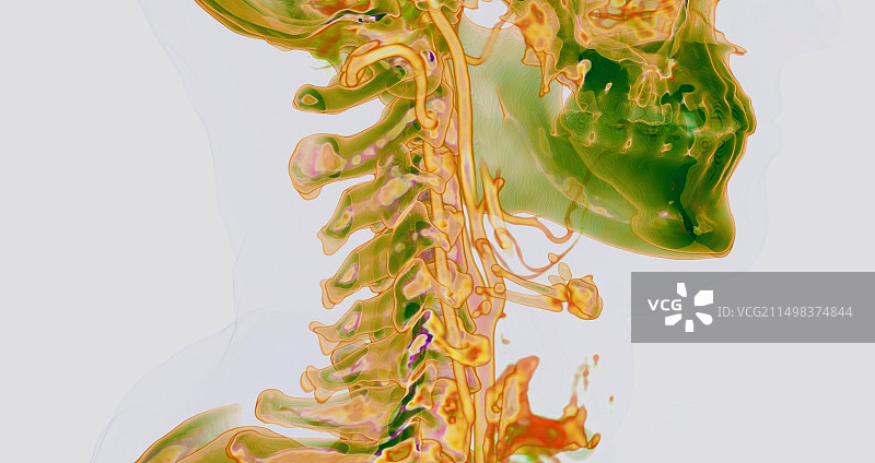 颈部动脉CT血管造影图片素材