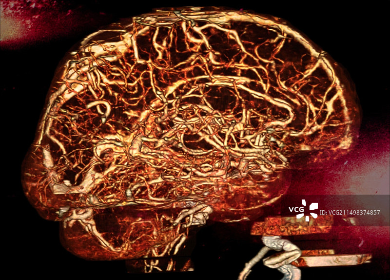 脑动脉CT血管造影图片素材