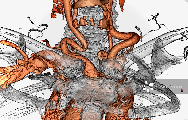 颈部和上胸部动脉CT血管造影图片素材