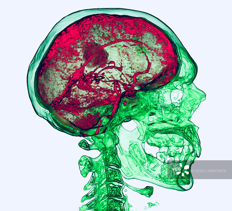 脑动脉CT血管造影图片素材