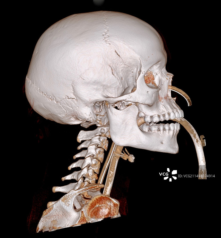 CT扫描插管病人图片素材