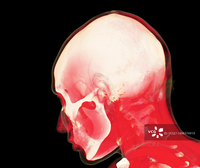 头部和颈部骨骼CT扫描图片素材