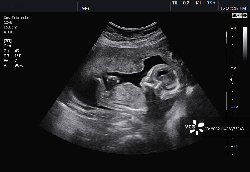 孕中期胎儿超声波扫描图片素材
