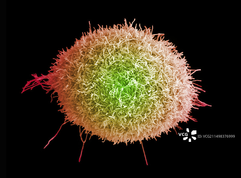 宫颈癌细胞扫描电镜图图片素材