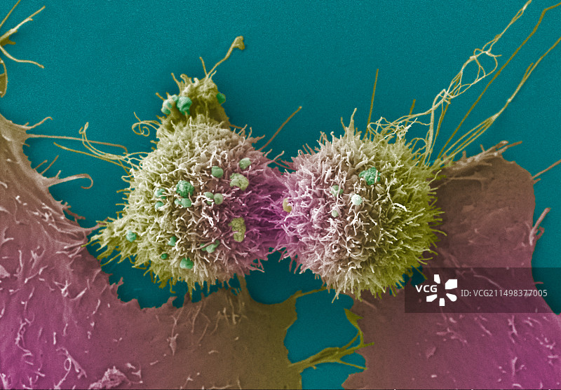 宫颈癌细胞分裂，扫描电镜图片素材