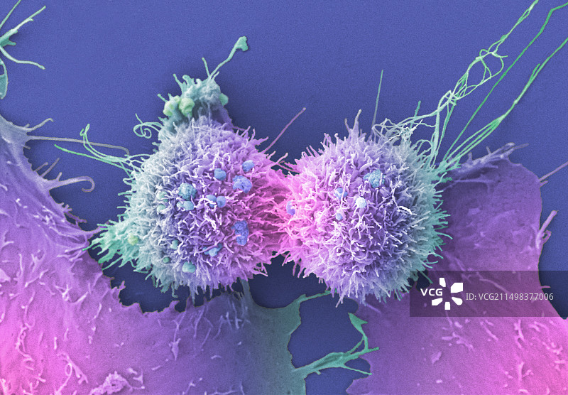 宫颈癌细胞分裂，扫描电镜图片素材