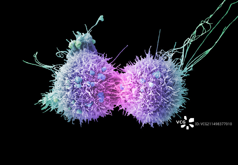 宫颈癌细胞分裂，扫描电镜图片素材