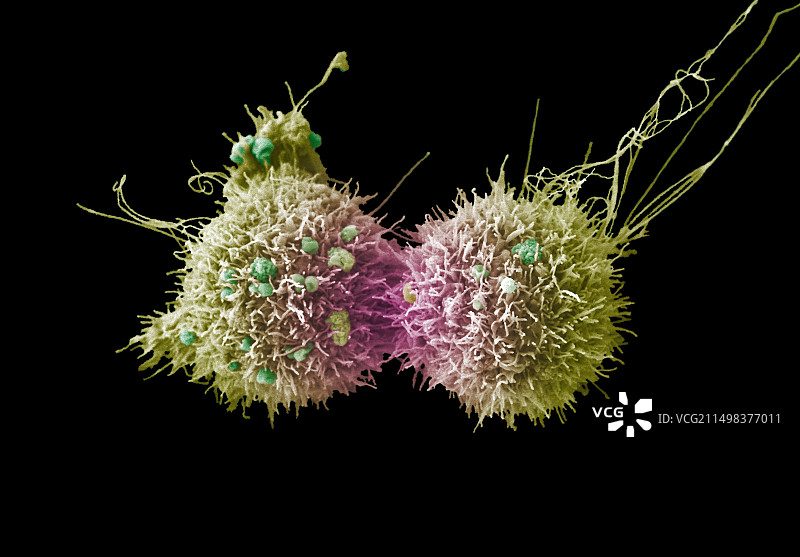 宫颈癌细胞分裂，扫描电镜图片素材