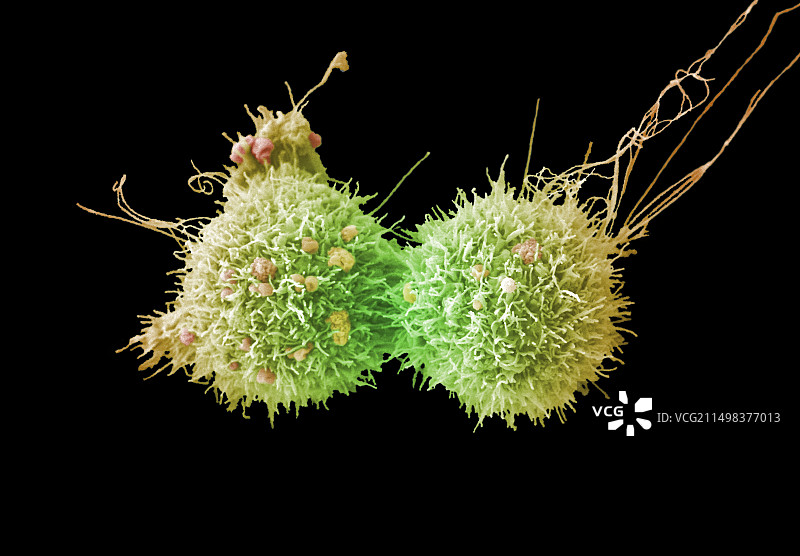 宫颈癌细胞分裂，扫描电镜图片素材