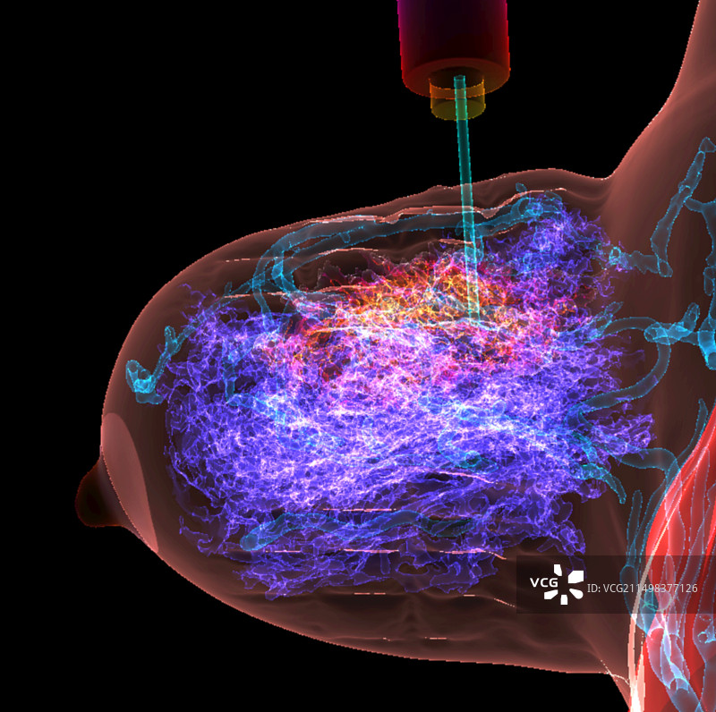 经皮乳腺活检，MRI扫描图片素材