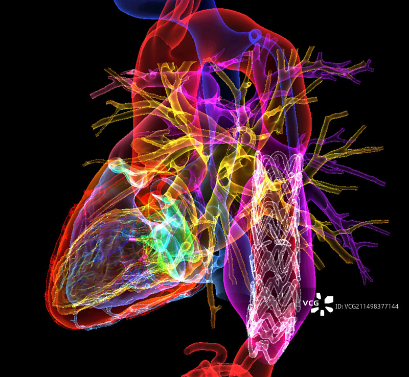 主动脉瘤支架CT扫描图片素材