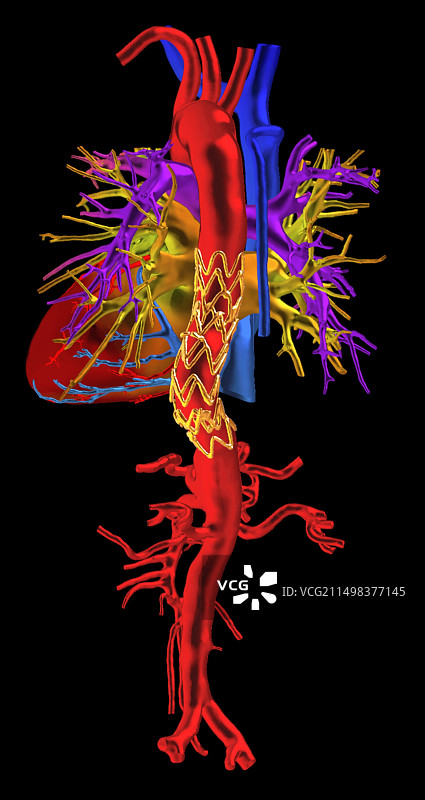 主动脉瘤支架CT扫描图片素材
