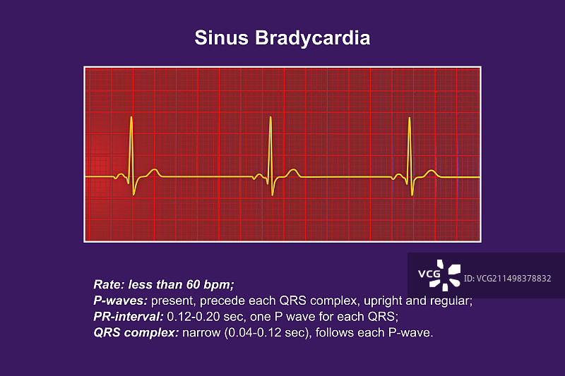窦性心动过缓心跳节律图图片素材