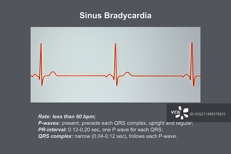 窦性心动过缓心跳节律图图片素材