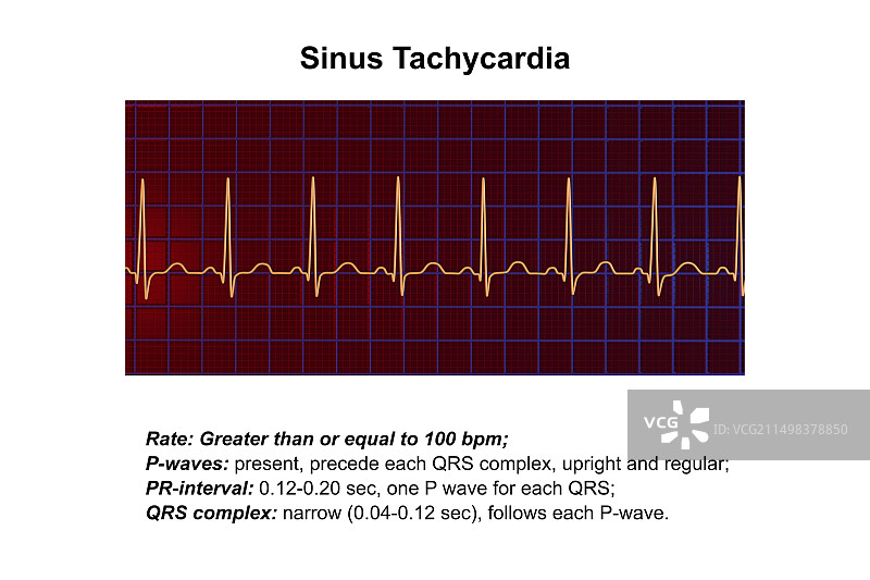 窦性心动过速心跳节律图图片素材
