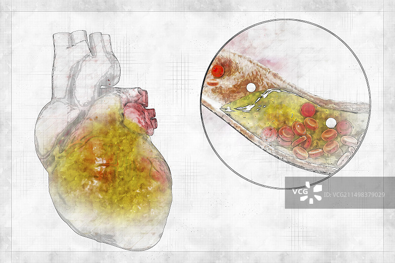 肥胖的心脏，图示图片素材