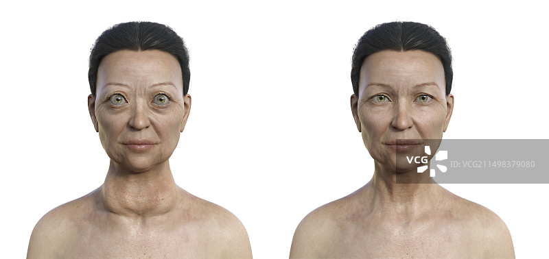 患有格雷夫斯病的女人插画图片素材