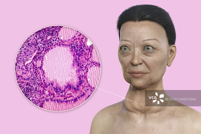 患有格雷夫斯病的女人插画图片素材