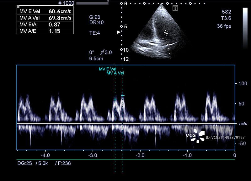 舒张功能障碍超声心动图图片素材