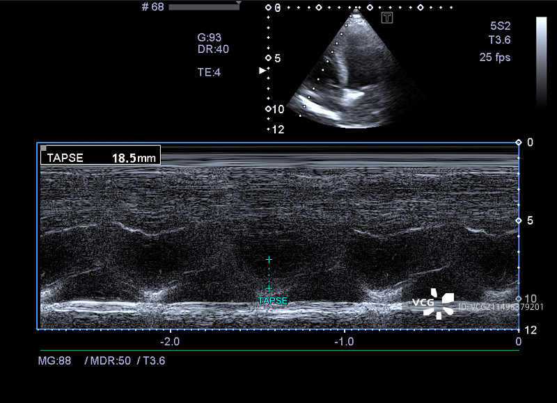 三尖瓣环平面收缩位移超声扫描图片素材