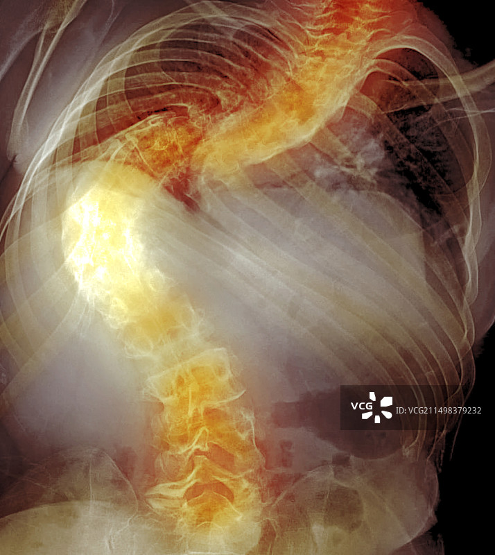脊柱侧弯X光片图片素材