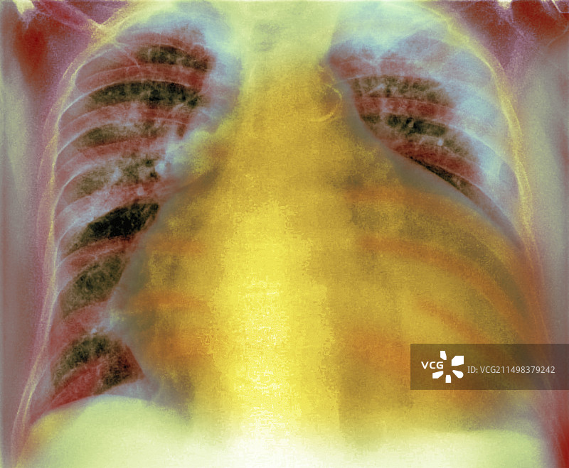 心脏扩大X光片图片素材