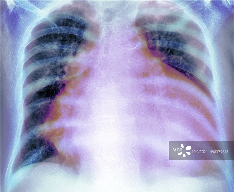 心脏扩大X光片图片素材