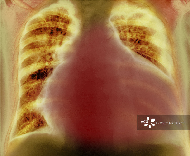 心脏扩大X光片图片素材