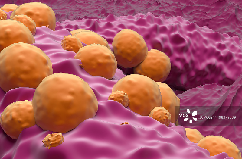 基底细胞癌示意图图片素材