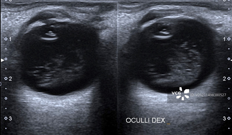 玻璃体出血眼部超声波图片素材