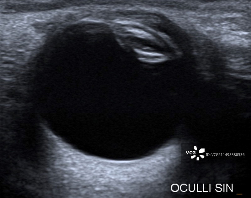 白内障眼部超声波检查图片素材