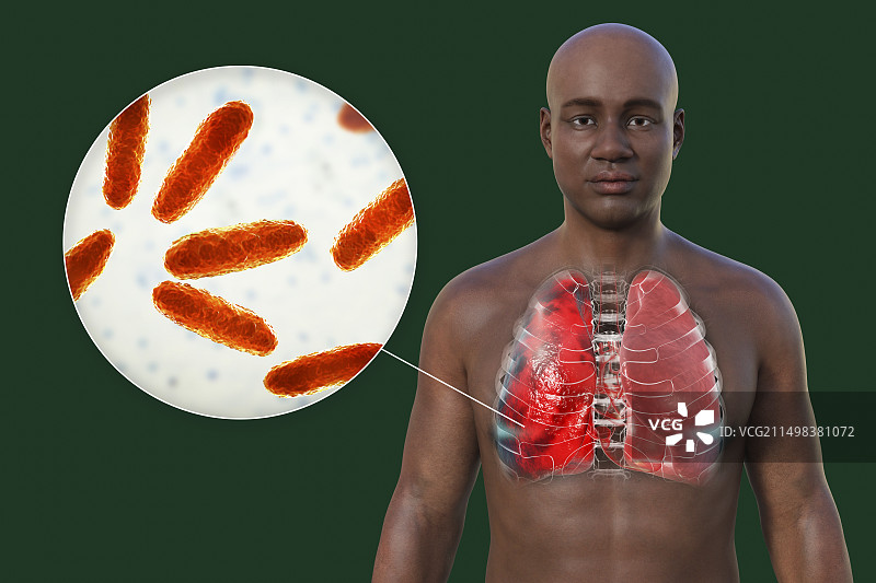 肺炎影响肺部的男人插画图片素材