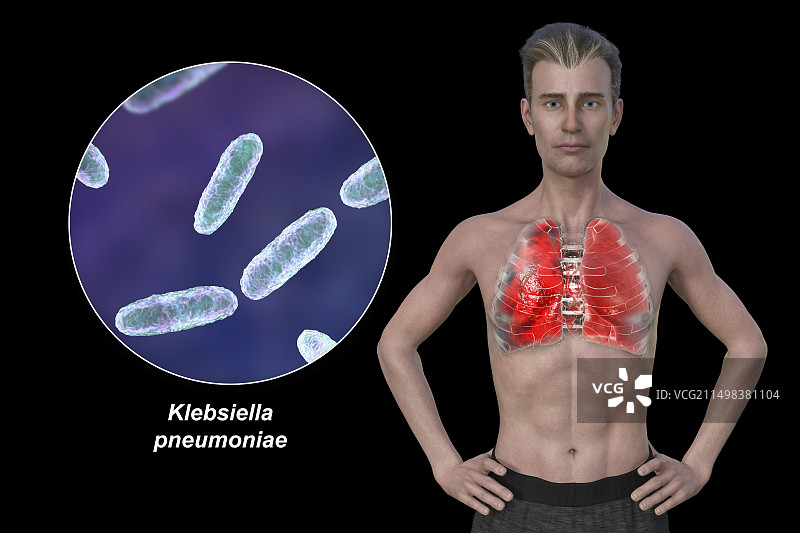 肺炎影响肺部的男人插画图片素材