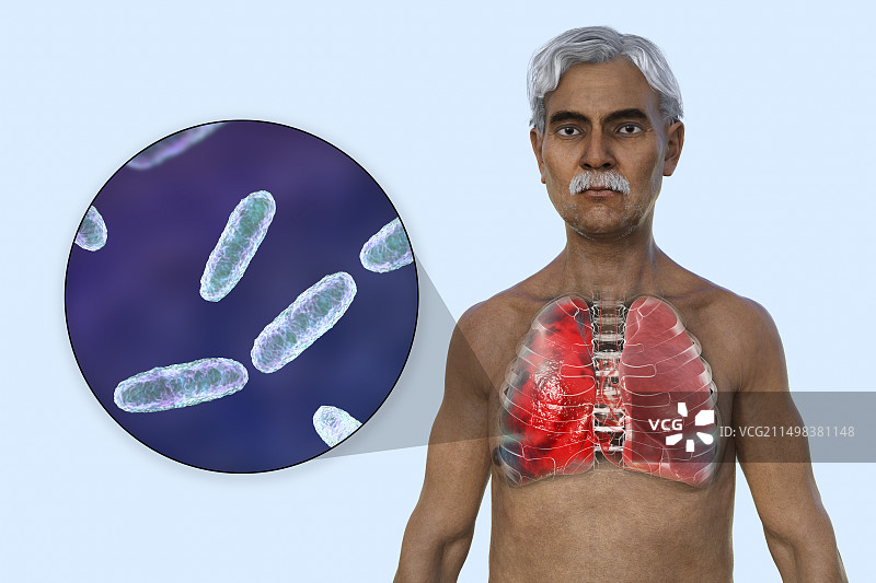 肺炎影响肺部的男人插画图片素材