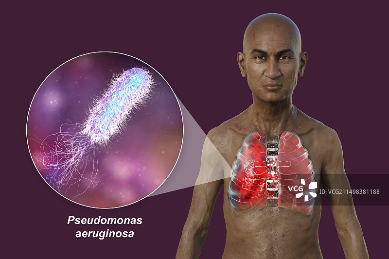 肺炎影响肺部的男人插画图片素材