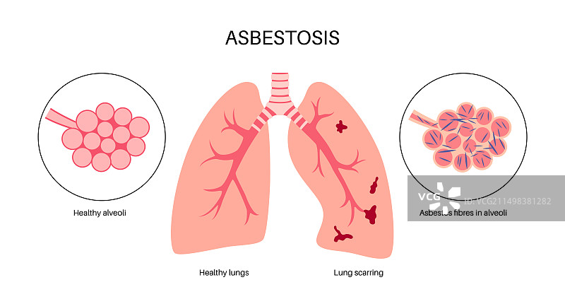 石棉肺疾病，图示图片素材
