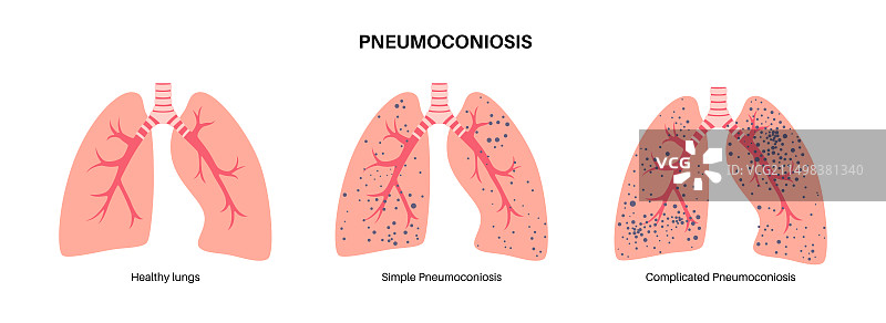 尘肺病插图图片素材