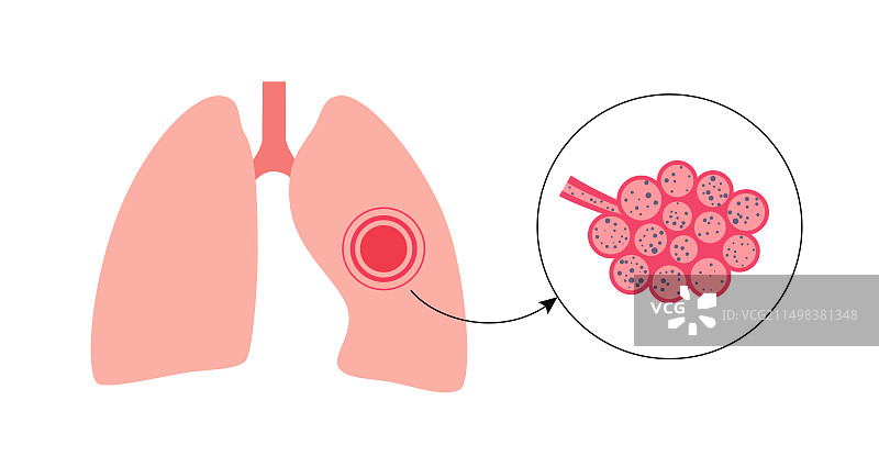 尘肺病插图图片素材