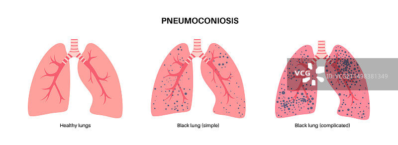 煤矿工人尘肺病，图示图片素材