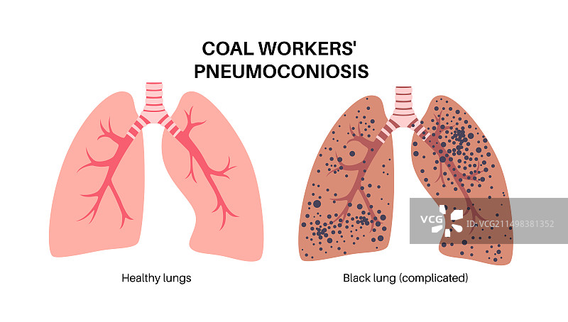 煤矿工人尘肺病，图示图片素材