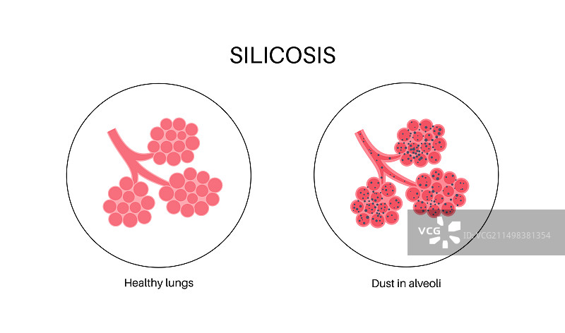肺部硅肺病粉尘，图示图片素材