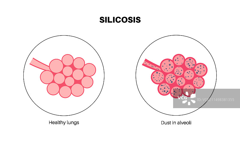 肺部硅肺病粉尘，图示图片素材