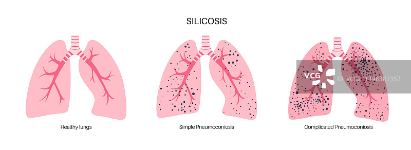 肺部硅肺病粉尘，图示图片素材