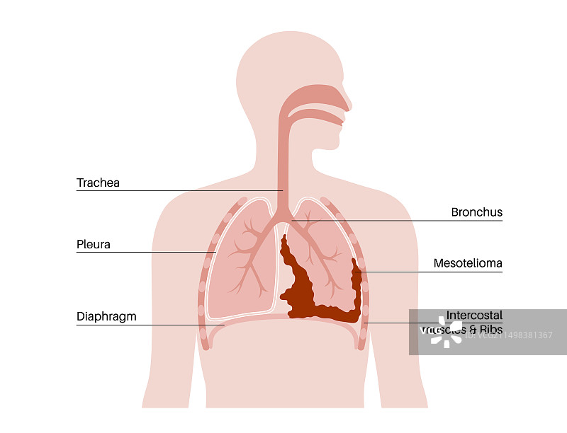 间皮瘤癌症疾病插图图片素材