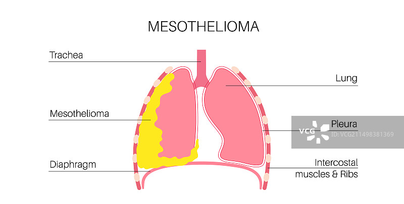 间皮瘤癌症疾病插图图片素材