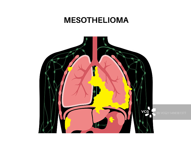 间皮瘤癌症疾病插图图片素材