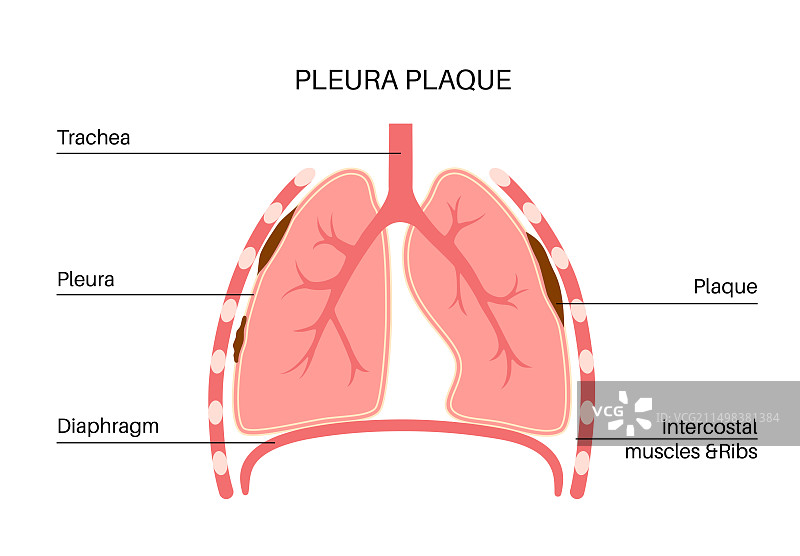 胸膜斑块图图片素材